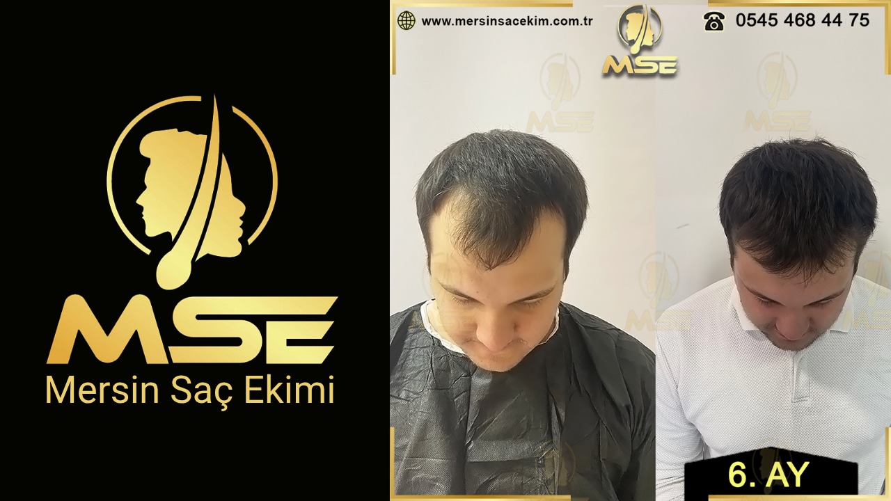 MERSİN SAÇ EKİMİ